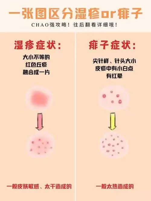 濕疹和痱子的區(qū)別